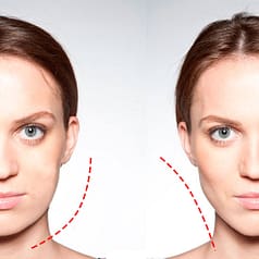 Удаление комков Биша