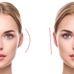 Отопластика