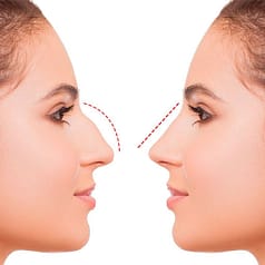 Ринопластика